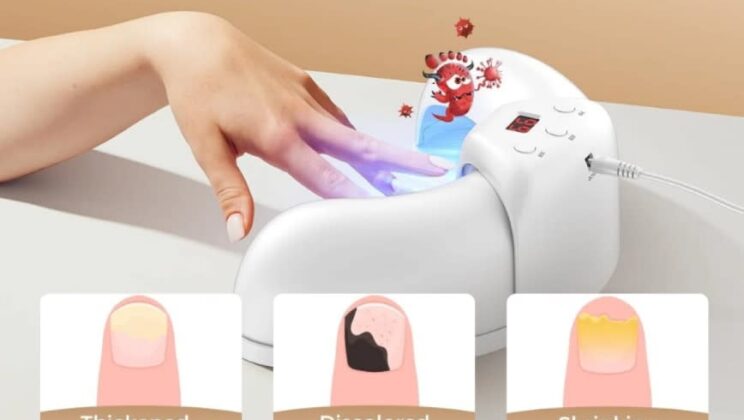 Fungabeam Reviews – Low-Level Laser Therapy (LLLT) Device for Toenail Fungus Relief!